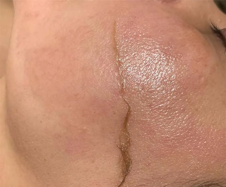 Facial Dermaplaning